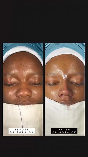 Graceful Rhinoplasty Transformation