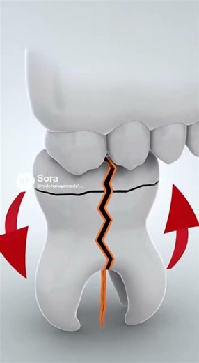 歯が割れる人の歯に出る3つのサイン⚠️見逃すと抜歯になることも#歯が割れる #食いしばり #歯がしみる#マウスピース矯正 #西村式スプリント