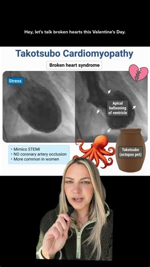 Blueprint PA (Formerly Rosh Review) on Instagram: "Cardio, but make it Valentine’s 💔🫀⁠ ⁠ Yes, broken heart syndrome is real, but so is stress. Enjoy this clinical breakdown, and don’t forget to protect your peace this week.⁠ ⁠ Be kind to your heart. 🩵 Take it from us: you’re doing better than you think.⁠ ⁠ #PAstudent #PASchool #FuturePA #PALife #pance"