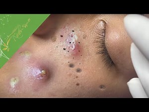 Relax Every Day with Xinh Spa Acne Treatment 8#134