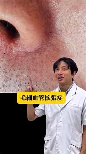 池袋駅前のだ皮膚科 院長 Shinji Noda MD on Instagram: "【この悩み、VビームやダーマVで治療できます👨🏻‍⚕️】 よく見ると、顔や体にこんなものできていませんか？🤔 いずれも気になる方は、治療することができます👨🏻‍⚕️ 顔にVビームを打った場合のダウンタイムが気になる、ダウンタイムが辛かった🥲という方は、ダウンタイムが少ないダーマVを試す価値あり💪 リールの最後に、VビームとダーマVを半顔ずつ照射した時のダウンタイムも載せているので、参考にしてみてください🙆‍♂️ 治療は初診、再診関わらず、当日予約なしでも承っております💪 いつの間にか増えていた…。ずっと気になっていた！という方は コメントで教えてください👀 ーーーーーーーーーーーーーーーー 【酒さの治療・症例写真など皮膚情報発信中💡】 @dr_shinji_noda 【アゼライン酸配合の酒さニキビ向け保湿のベーシックケアAZ🧴】 @basic_care_official ーーーーーーーーーーーーーーーー 🏥池袋駅前のだ皮膚科 📍東京都豊島区東池袋1丁目2−2東池ビル3階 【