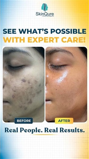 Amazing Skin Transformations | Real Before & After Results | SkinQure