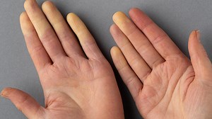 Raynaud's Phenomenon: Symptoms, Precautions, and Treatment