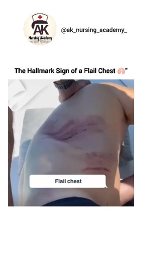 Ak Nursing Academy | A true respiratory emergency! Do you know how to manage a Flail Chest? 🚨🫁 A flail chest occurs when multiple adjacent ribs are broken in... | Instagram