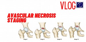 Avascular Necrosis Staging [VLOG]