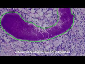 Actinomycosis in liver with Periodic acid Schiff PAS Staining