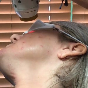 #NeoClearbyAerolase is the in-office acne solution for all forms of acne, no prescription medication required. Become a NeoClear practitioner - send us a message Practitioner: SkinAppeal Spa | Aerolase