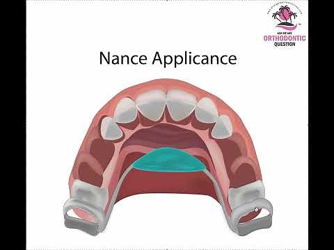 Top 4 Uses of a Nance or TPA Appliance in Orthodontics