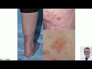 (Part 1 of 2) Dermoscopy Primer - Ashfaq Marghoob, MD