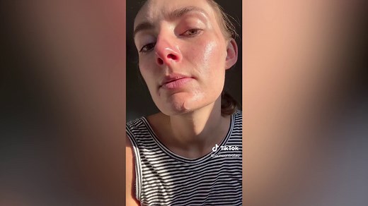Woman reveals pimple patch results compared with popping a zit