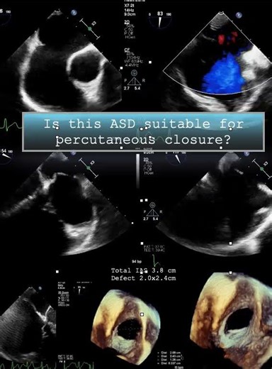 Is this ASD suitable for percutaneous closure?