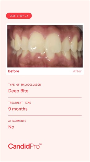 A deep bite malocclusion is common, but many patients don’t...