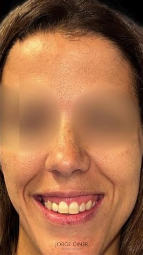 Solución a sonrisa gingival