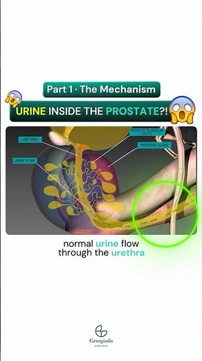 Urine Inside the Prostate?! | #prostatitis symptoms (Part 1)