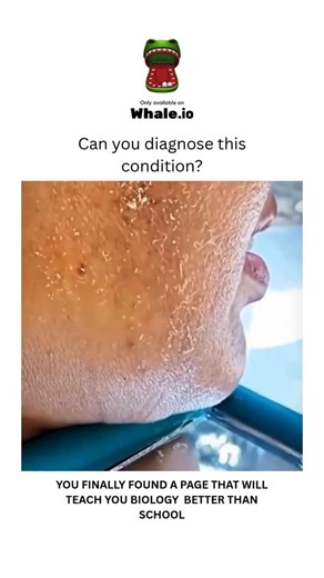 BIOLOGY | MEDICAL | HEALTH on Instagram: "Ans:- Cutaneous myiasis is a skin infestation by fly larvae (maggots), most commonly causing boil-like lesions, open wounds, or movable lumps. This condition is categorized by the fly larvae’s behavior, resulting in furuncular, wound, or migratory types. Diagnosis and treatment involve removing the larvae, often requiring irrigation and debridement of the wound. These white worms coming out of the skin Many people mistake this for acne or dead skin, but 