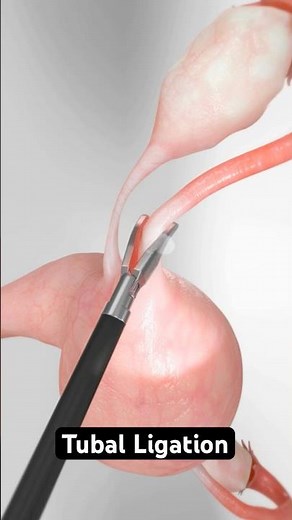 Three methods for permanent female sterilization (3D Animation)