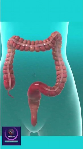 Colectomy, Removal of Colon #shorts #education