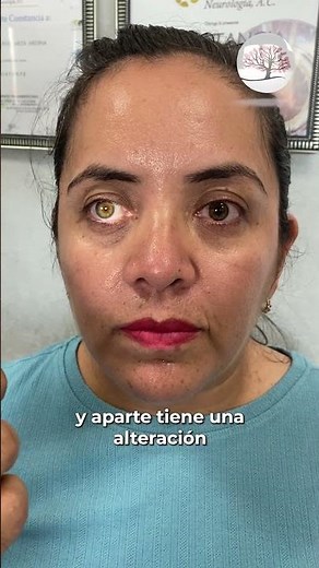 Pupila tónica de Adie #neurology #pupila #educaciónmédica #neuro