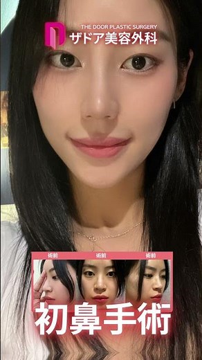 鷲鼻や長い鼻を改善し、自分に似合う鼻へ大変身⭐ #美容整形 #鼻尖形成 #鼻整形 #整形 #韓国 #韓国美容整形 #韓国整形 #鷲鼻矯正 #鼻整形 #垢抜け #ビフォアーアフター #小鼻縮小