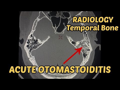 Acute Otomastoiditis | Ct scan |Radiology |