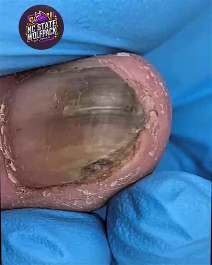 Safe Foot and Nail Maintenance Plans for Seniors #FootWellnessUSA #FootCareTips #SeniorHealth | NC State Wolfpack on TheWolfpacker.com