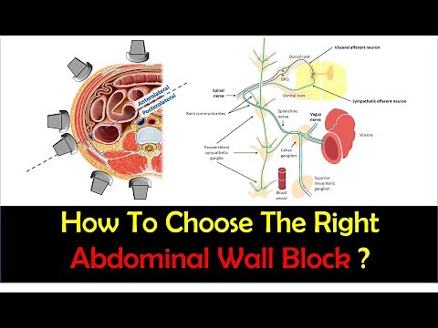 Abdominal Wall Blocks for Surgery - How To Choose the Right Technique?