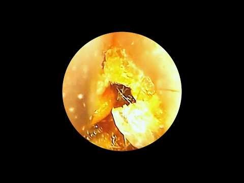 The Truth About Yellow Earwax Is It Healthy Or Harmful