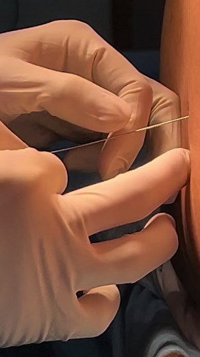 Spinal Anesthesia for Cesarean Section Explained
