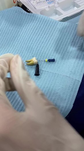 Effective Broken File Removal Techniques in Dentistry