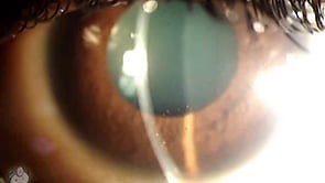 KP (keratic precipitates) on the back of the cornea (Video) - TimRoot.com