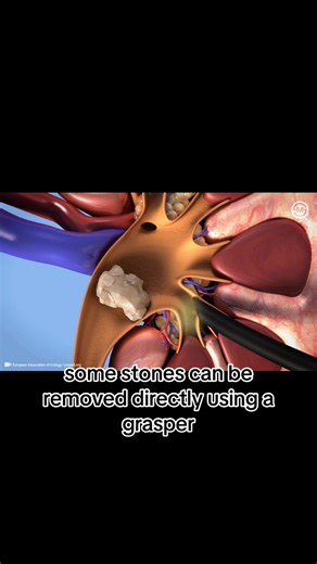 Percutaneous nephrolithotomy(PCNL) #finalyeardiaries