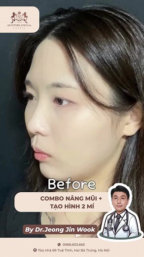 Thay đổi diện mạo với Combo nâng mũi tạo hình mí tại AD #adinternationalclinic #adclinic