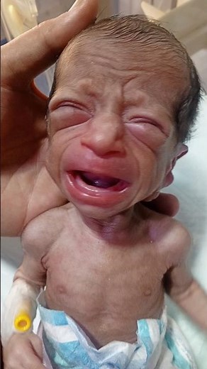 LBW Baby in NICU Low Birth Weight Care #cute #baby #neonatologist #cutebaby #babycare