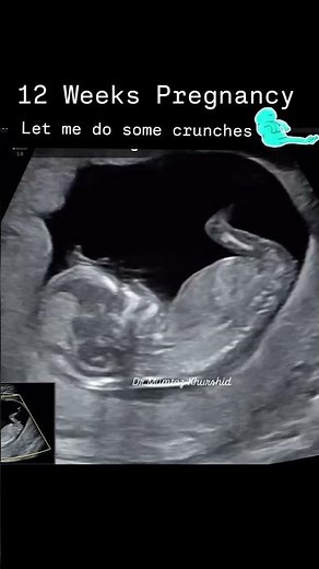 12 Weeks Pregnancy On Ultrasound