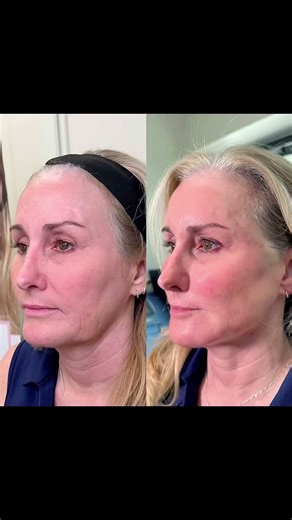 PDO Thread Lift: Your Non-Surgical Facelift Solution! 💫