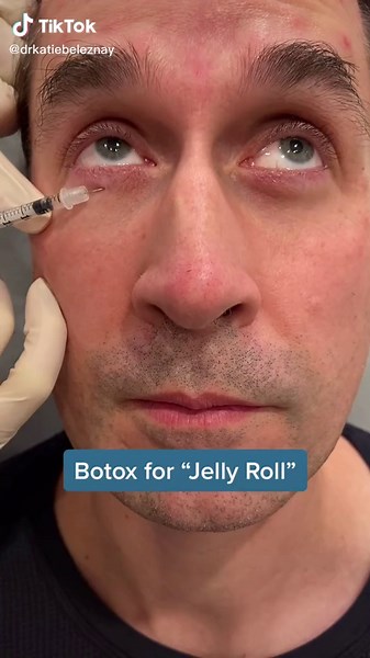 Botox for under eye “jelly roll” #botox #dysport #tiredeyes #wrinkles #dermatologist #drkatiebeleznay