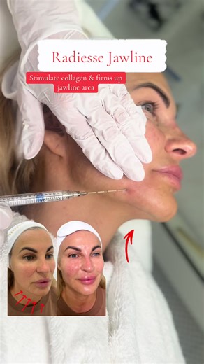 Enhance Your Look with Radiesse: Treatment Insights
