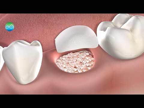 Bone Grafting | Kitsap Oral, Maxillofacial & Dental Implant Surgery