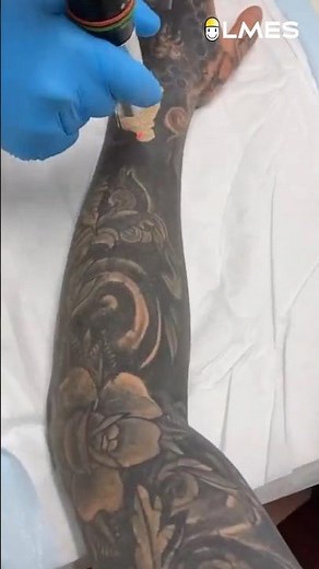 How to remove a Permanent Tattoo? Laser vs. Tattoo ☠️