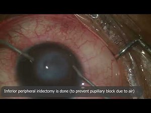 Surgical management of acute hydrops