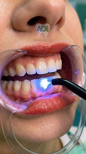 How We Save a Decayed Front Tooth (Seamless Cavity Repair) 🦷 #shorts