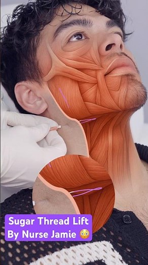 This Non-Surgical Treatment Creates a Lifted Look