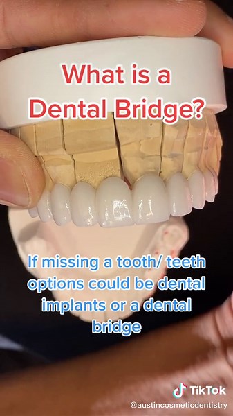 Understanding Dental Bridges: Options for Missing Teeth