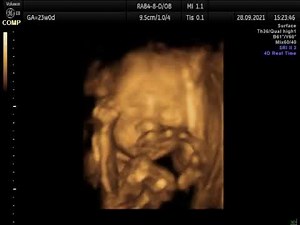 4D ultrazvučni snimak bebe u 23 nedelji trudnoće - Ginekološka ordinacija Anđelić. Vođenje trudnoće.