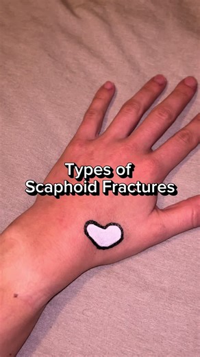 Not all scaphoid fractures are created equal Distal pole, waist, and proximal pole fractures differ in blood supply, healing time, and management… location matters more than you think 🦴🤚 The closer the fracture is to the forearm, the less blood supply the bone receives, which can mean longer healing times and a higher risk for complications That’s why early diagnosis, proper immobilization, and the right rehab plan are key for getting back to sport, work, and daily life safely 🤌 #occupational