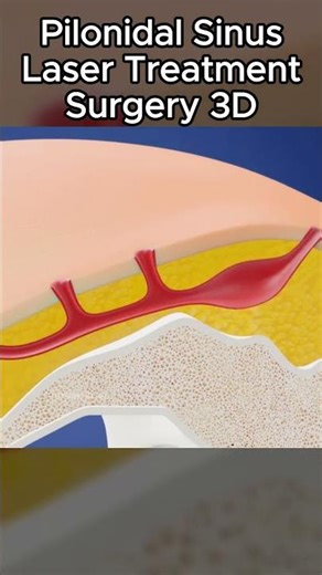 Pilonidal SinusLaser Treatment Surgery 3D