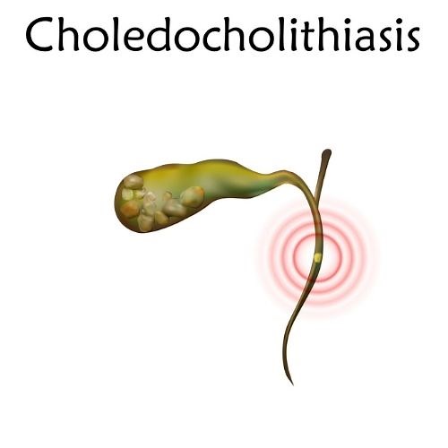 Can you Still Get Gallstones after Having your Gallbladder Removed?, Gastroenterologist Explains. - Oh My Gut