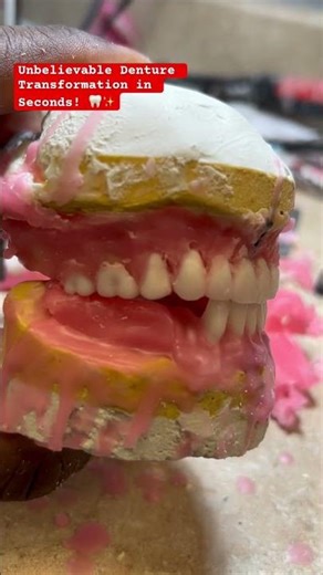 Unbelievable Denture Transformation in Seconds! 🦷✨ #dentures #dentist #teethdecay #shortvideo
