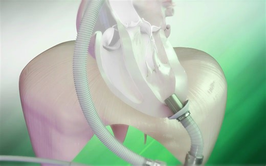 人工心脏（左心辅助装置LVAD）的工作原理