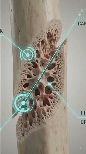 Oblique Fracture Explained: Diagonal Bone Break 🦴